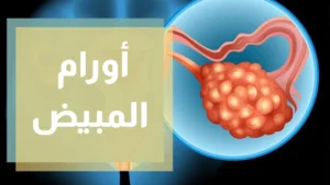 سرطان المبيض - علاج أورام المبيض مع افضل دكتور جراحة اورام في مصر - د. عمرو نوفل