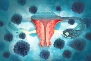 سرطان الرحم - علاج أورام الرحم مع افضل دكتور جراحة اورام في مصر - د. عمرو نوفل