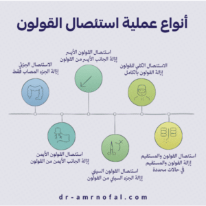 ما أنواع عملية استئصال القولون؟